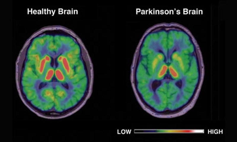 6m suffer from Parkinsons disease worldwide: study