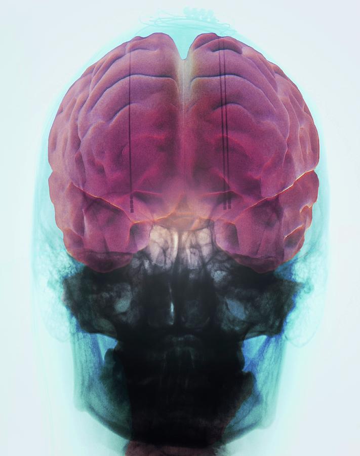Brain Implants For Parkinson