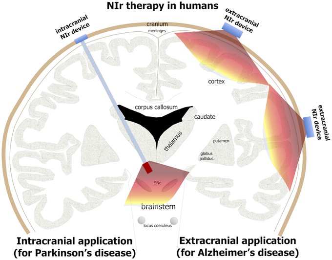 Brain Regeneration: Can Infrared Light Reverse Parkinsonâs and
