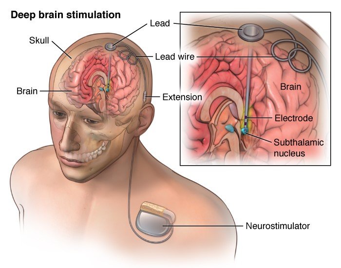 Brain Stimulation as Addiction Treatment: Science Fiction, or an ...
