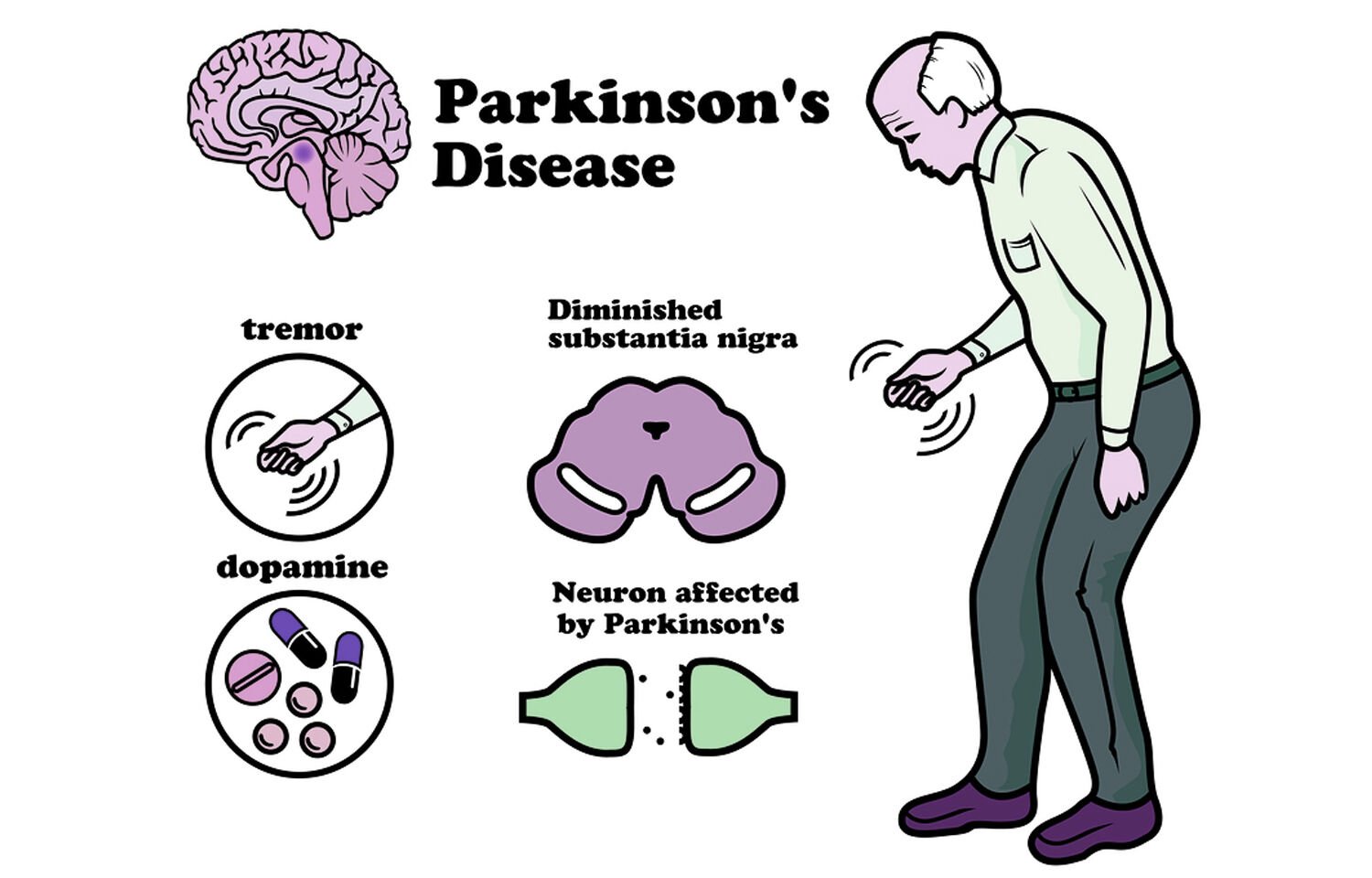Cognitive Decline Greater In Male Parkinson
