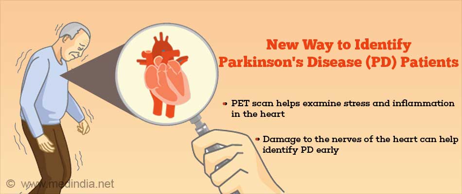 Damage to Heart Nerve Cells can Identify Parkinsons Disease