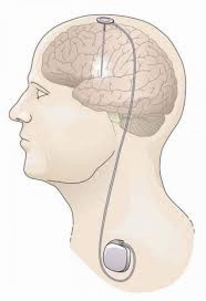 Deep Brain Stimulation at Two Different Targets Produces Similar Motor ...