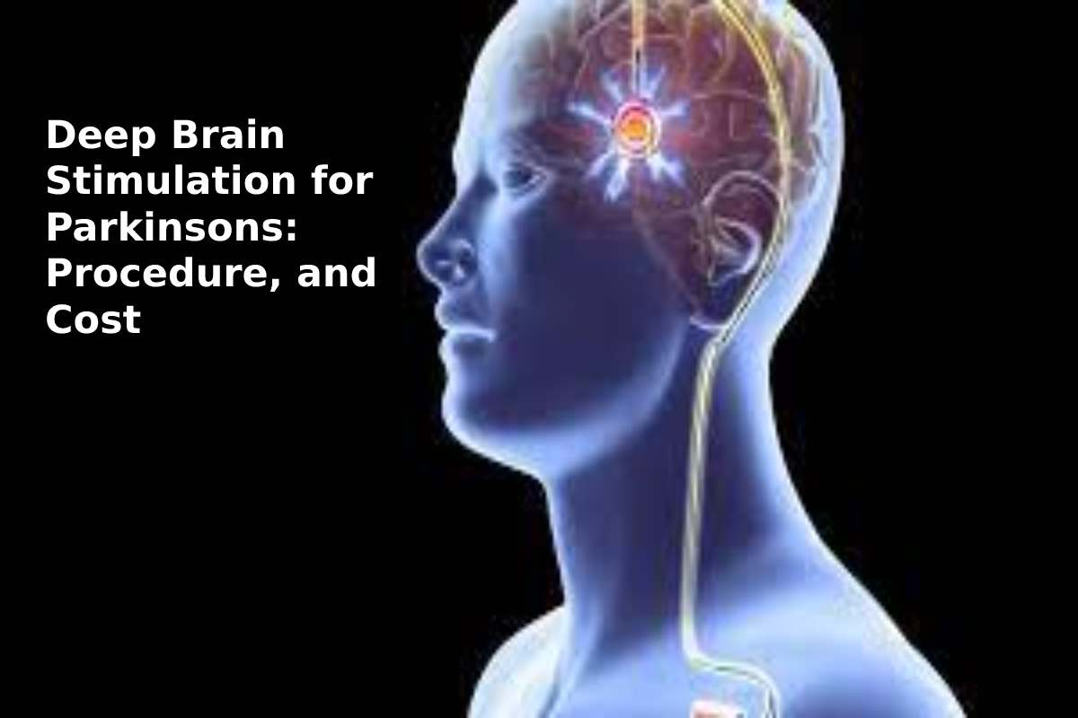 Deep Brain Stimulation for Parkinsons: Procedure, and Cost ...
