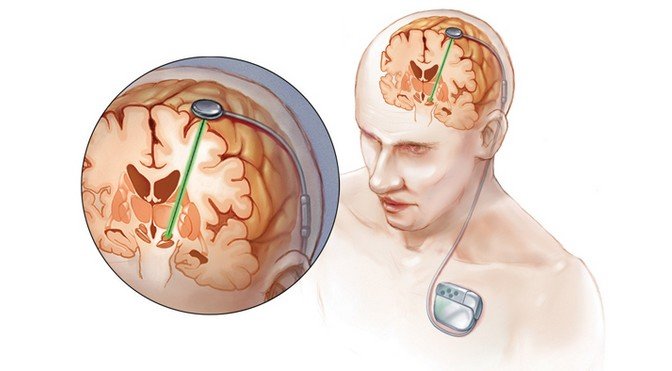 Deep brain stimulation: The bleeding edge of neurohacking and ...