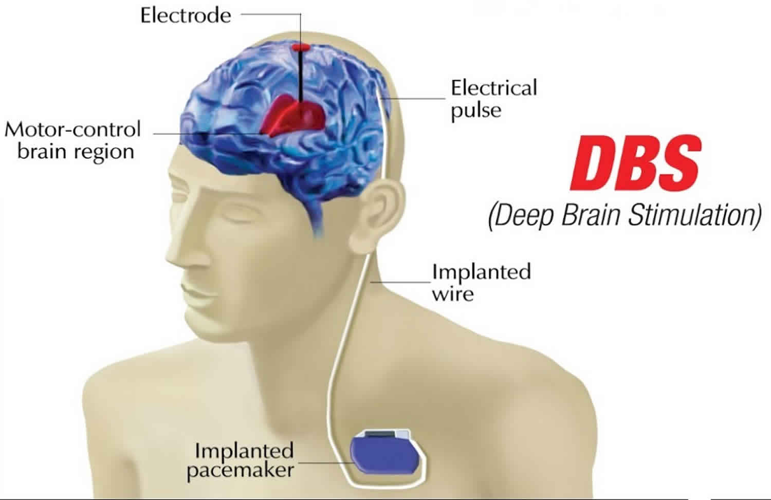 Deep brain stimulation, uses, success rate &  side effects