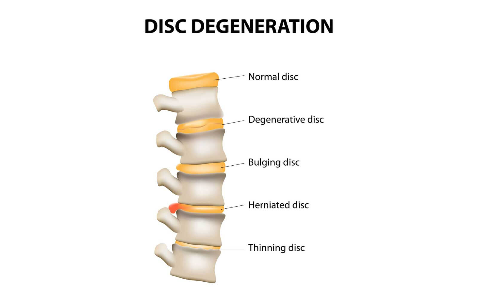 Degenerative Disc Disorder