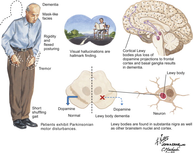 Dementia with Lewy Bodies (Including Parkinsonâs Disease ...