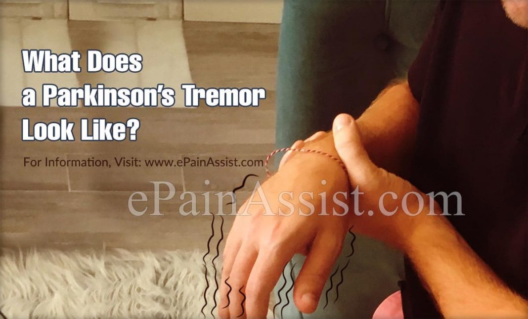 Do Tremors Come And Go With Parkinson