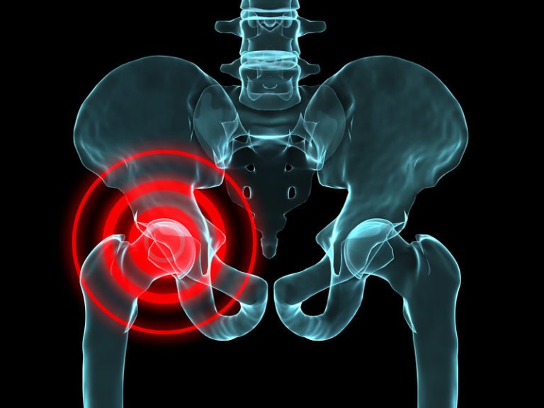 Do you have chronic hip pain and not know why? You are not ...