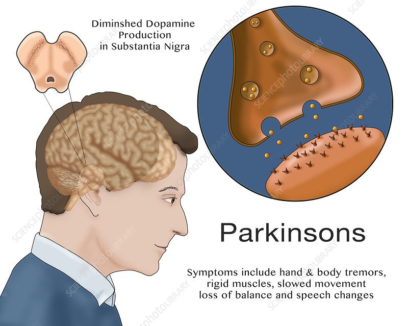 Dopamine &  Parkinson