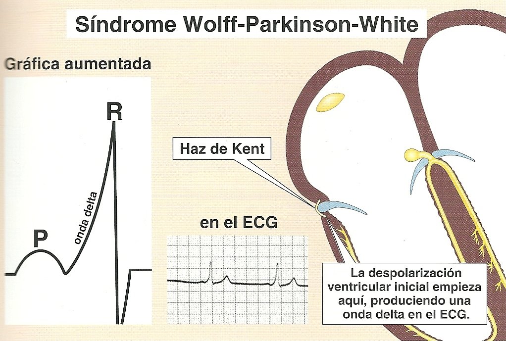 Electrocardiograma y Medicina General: Síndrome de Wolff ...