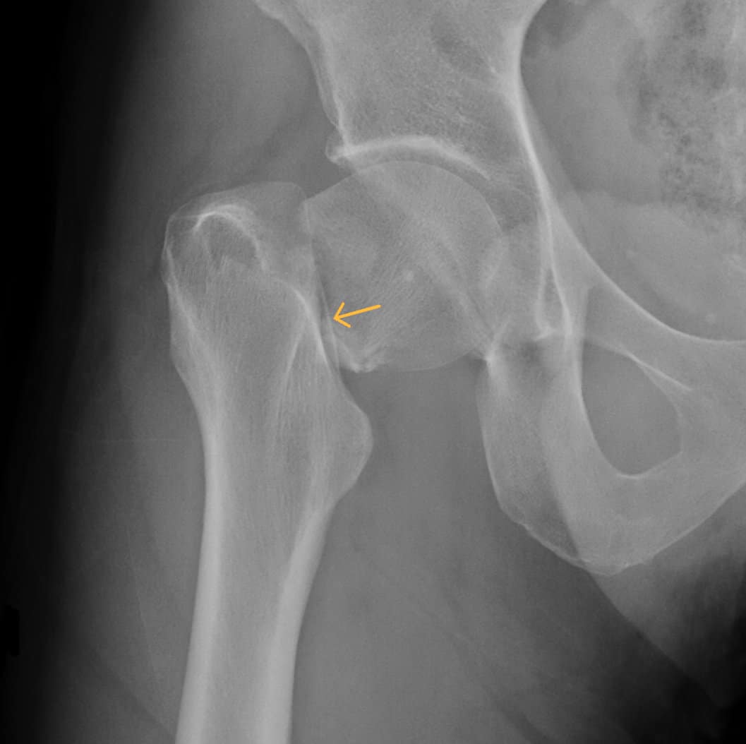 Five questions to ask a doctor about your hip fracture