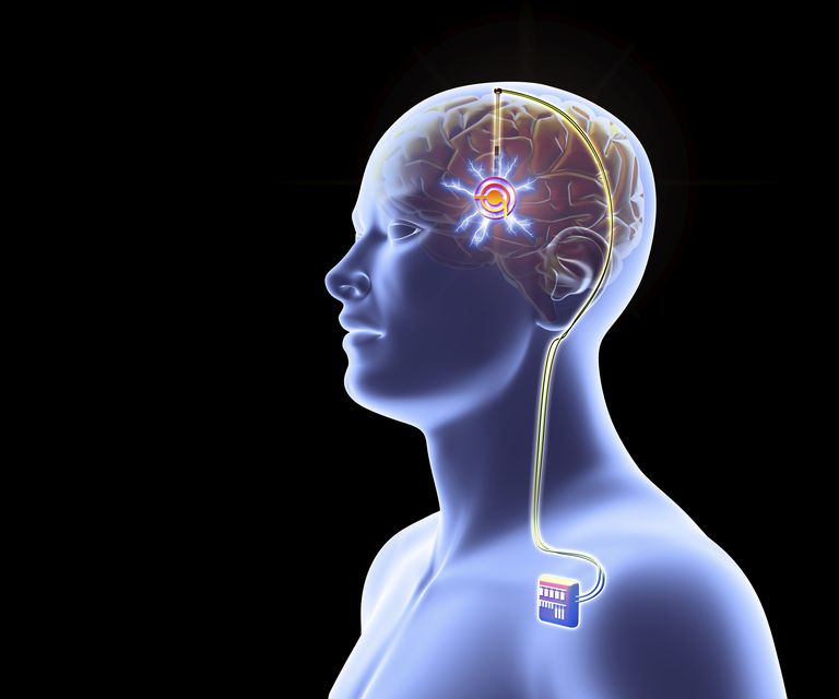 Global Deep Brain Stimulation Devices Market Average Growth Rate is 11 ...