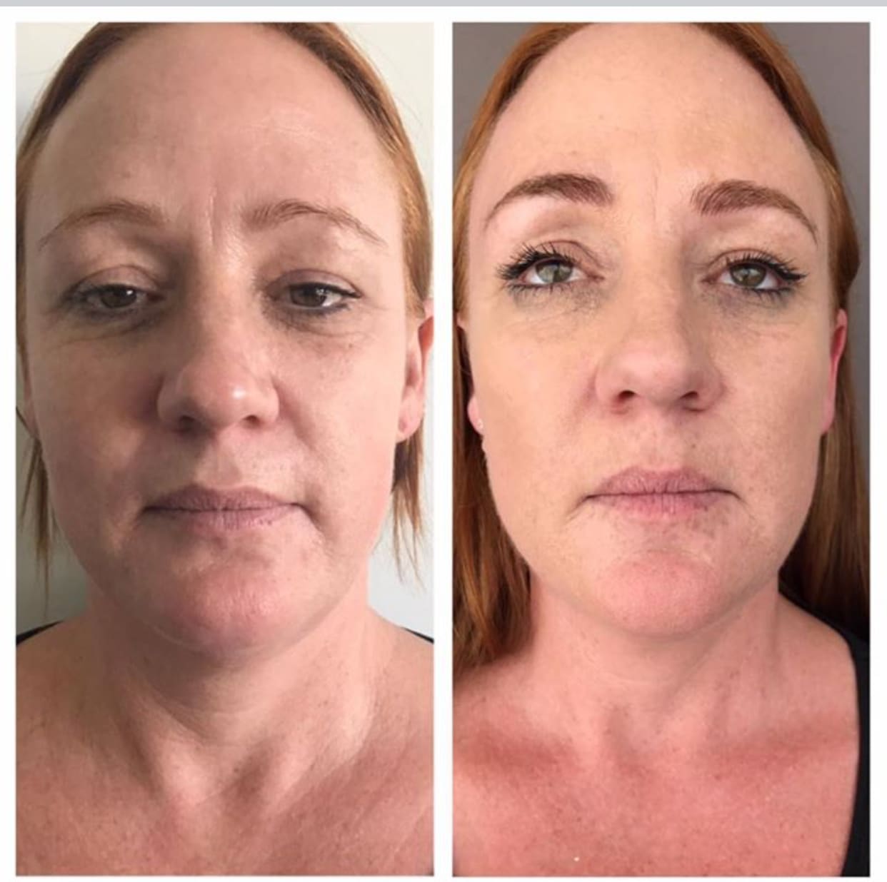 HIFU Face and Neck Lifts