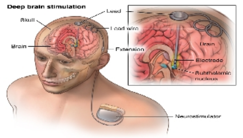 How does a deep brain stimulation device work?