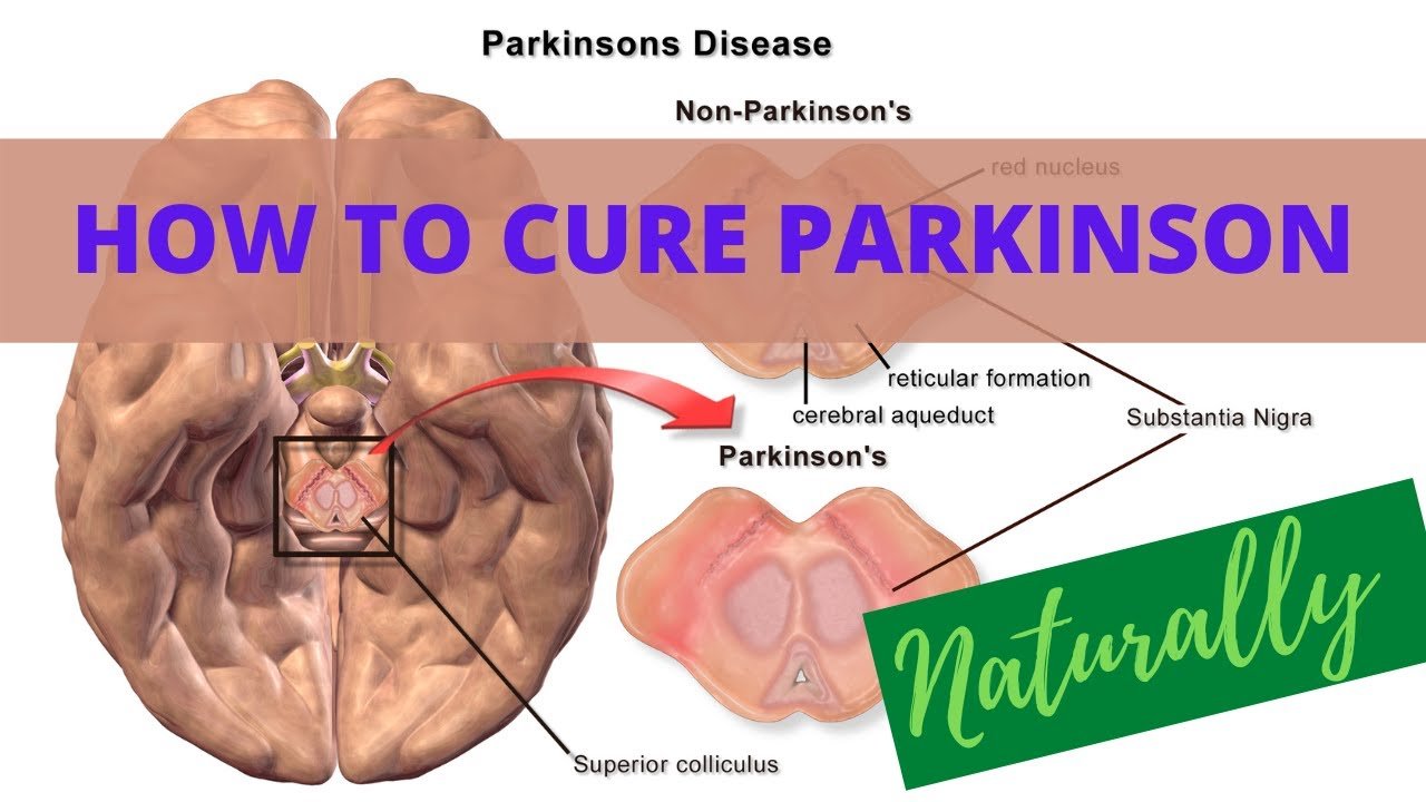 How To Cure Parkinson Naturally