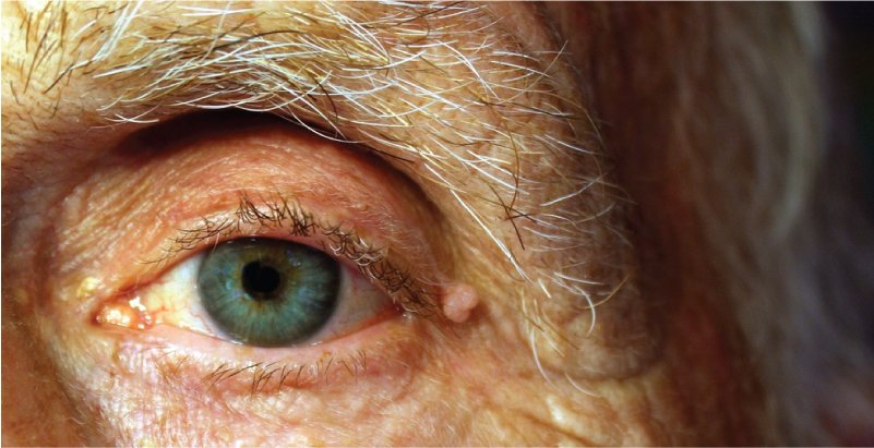How vision gets affected by Parkinsons disease