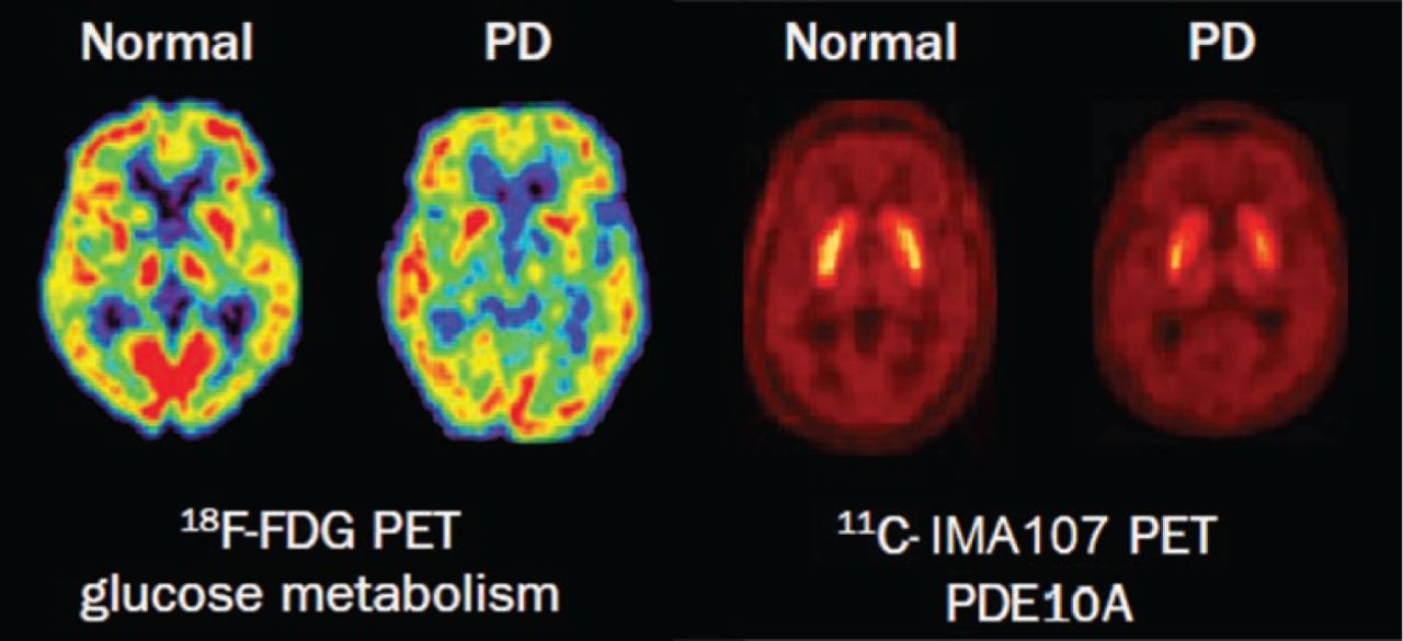 Imaging in Parkinsons disease