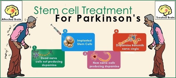 Is stem cell therapy effective for Parkinson