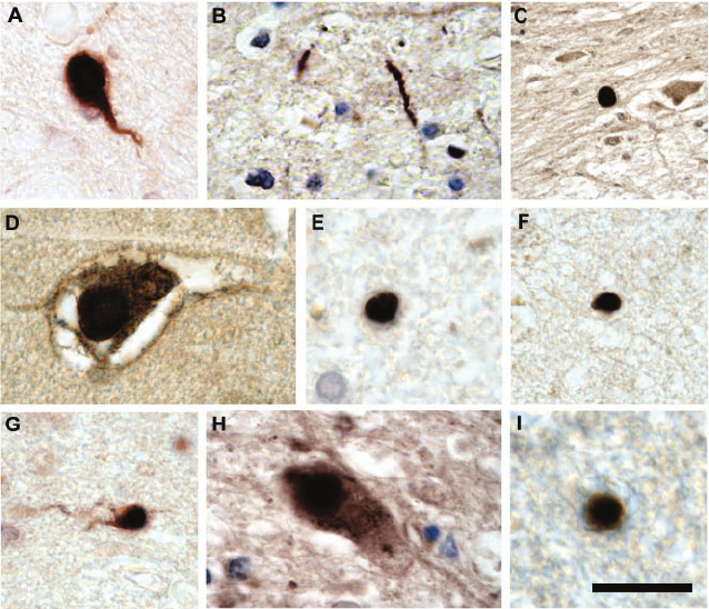 Lesions from tissue of human patients with Parkinsons ...