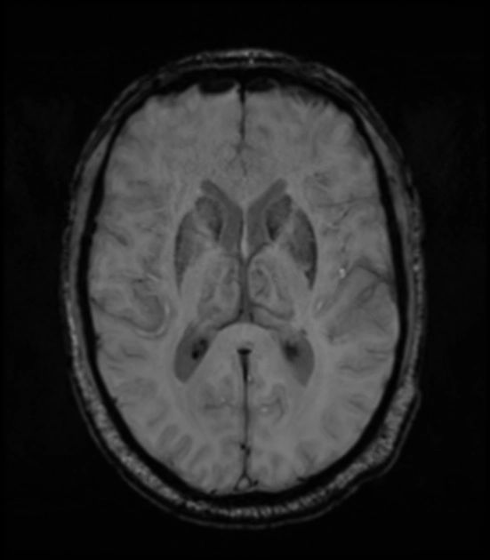 Loss of swallow tail sign in Parkinson disease