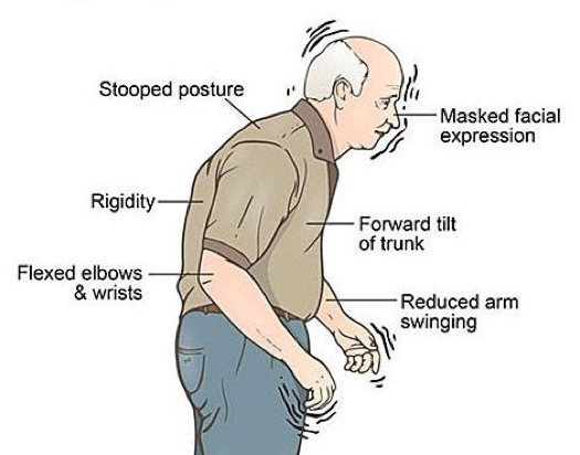 Managing the Symptoms of Parkinsons Disease