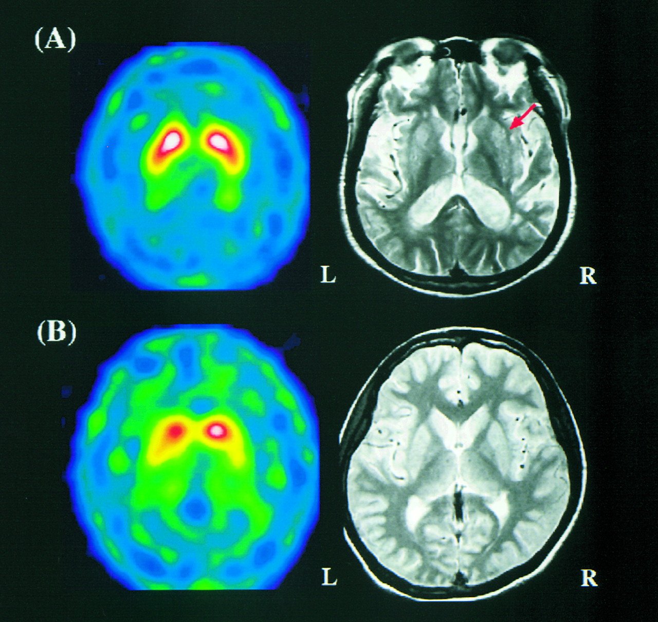 mini stroke  The Science of Parkinson
