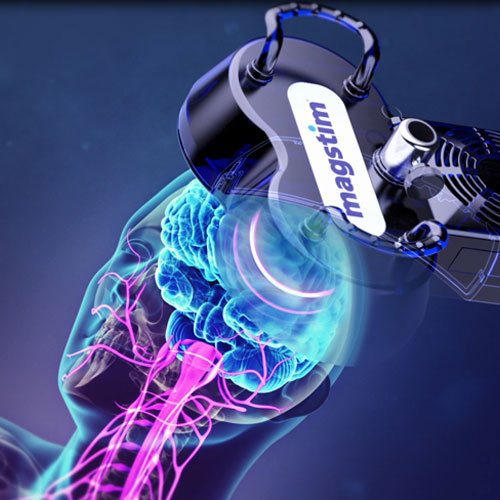 Neuronavigation Guided TMS