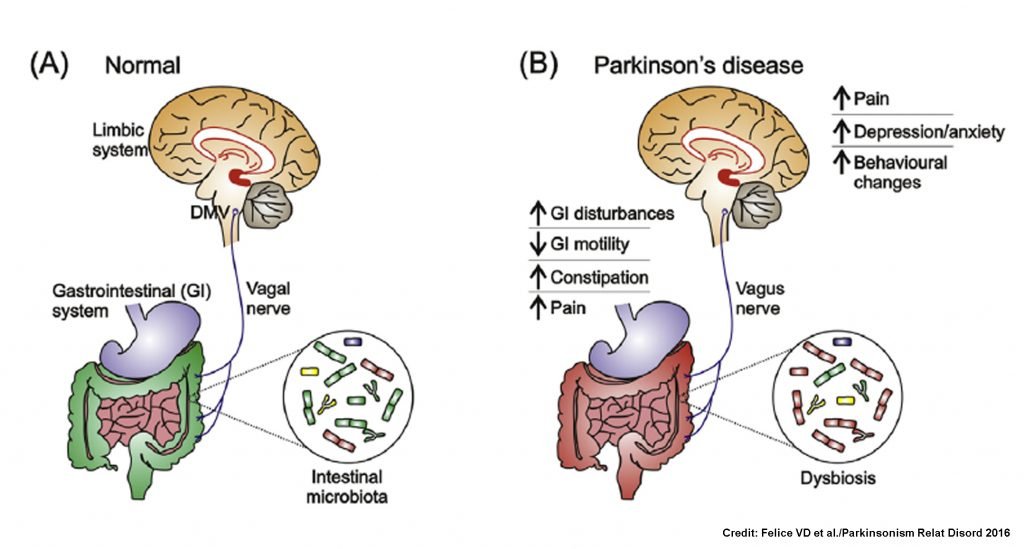 New insights into the role of gut microbiota in Parkinson ...