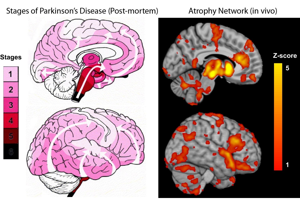 New study maps the progression of Parkinsons disease within the brain ...