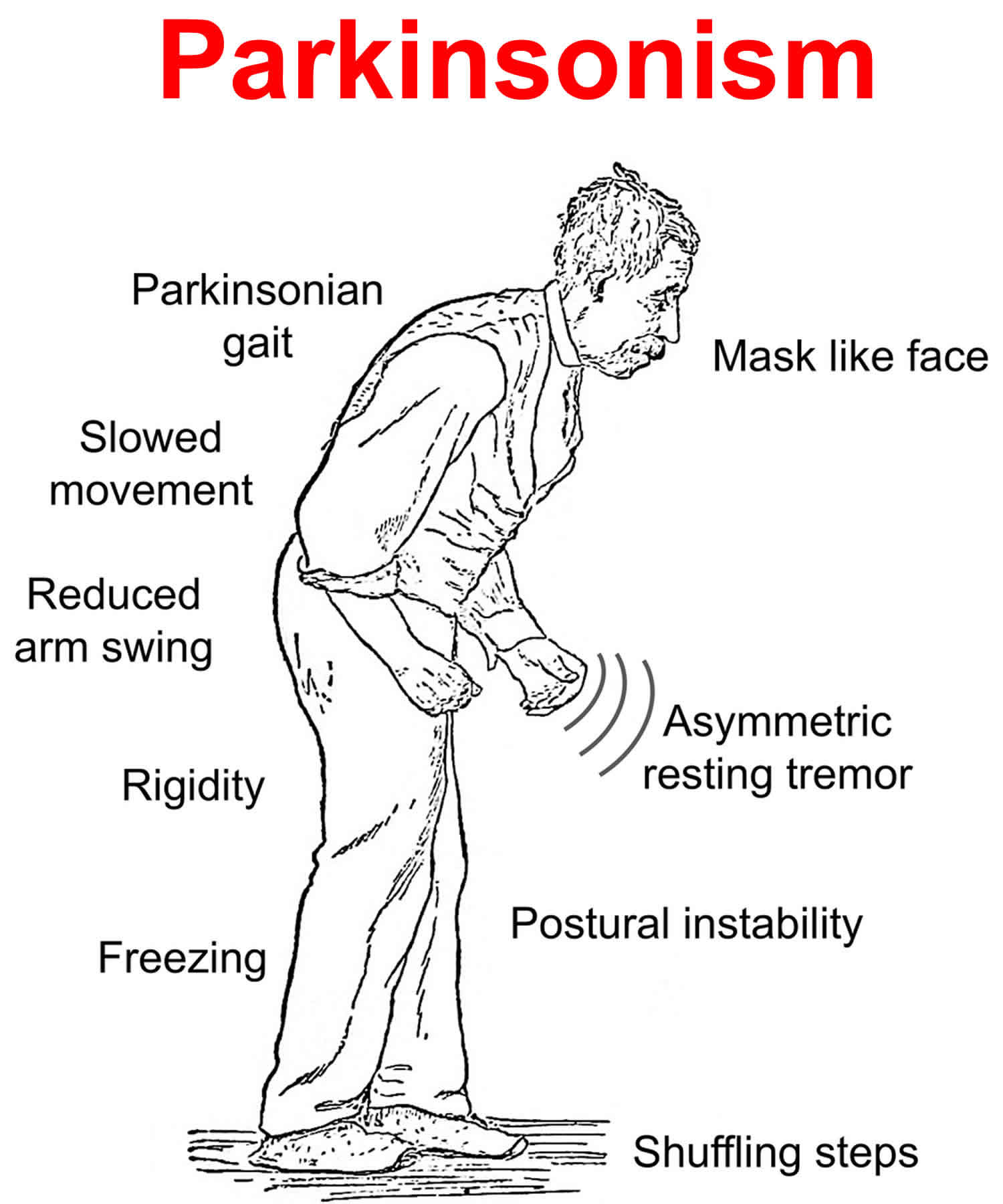 Parkinsonism causes, symptoms, diagnosis, treatment &  life expectancy