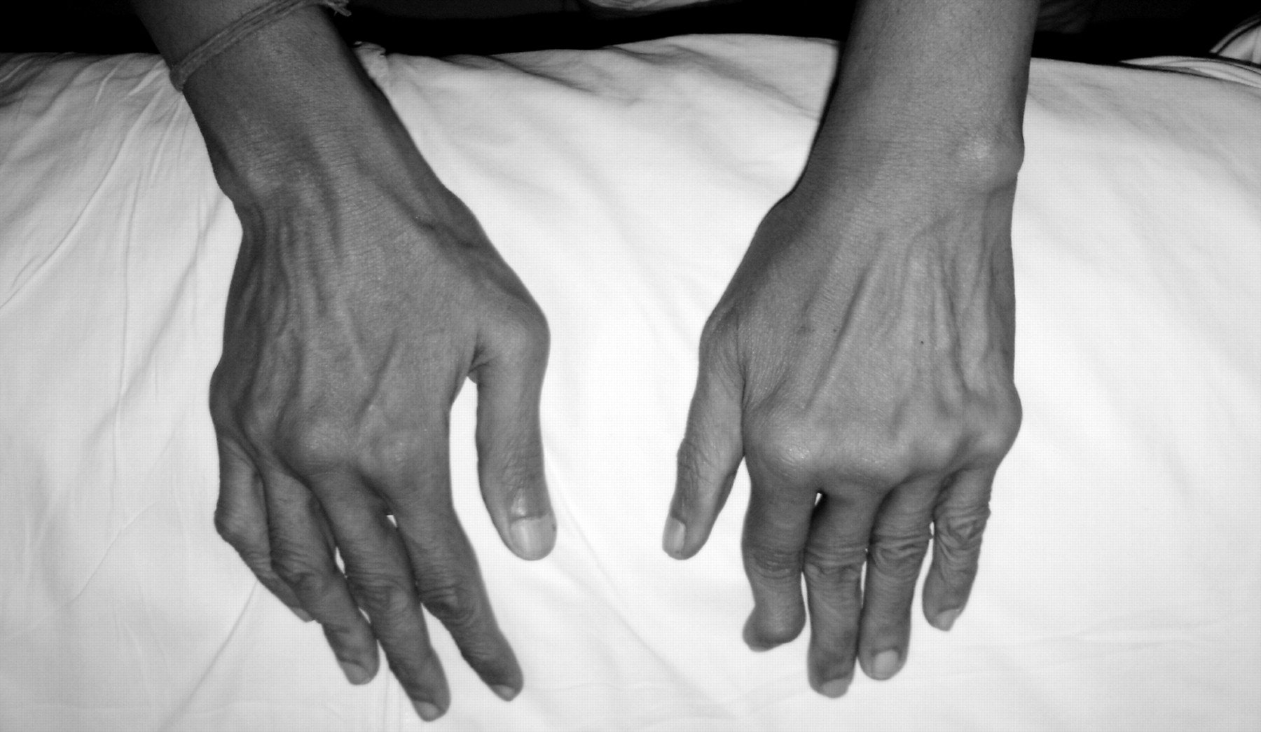 Parkinsonism Mimicking Rheumatoid Arthritis