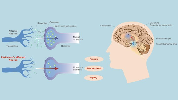 Parkinsons And Dopamine