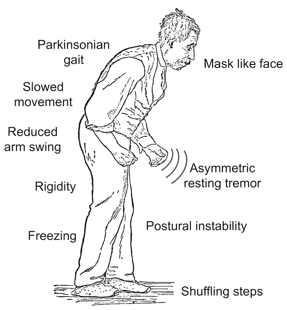 Parkinsons Disease Causes A Shuffling Gait And A Mask Like Facial ...