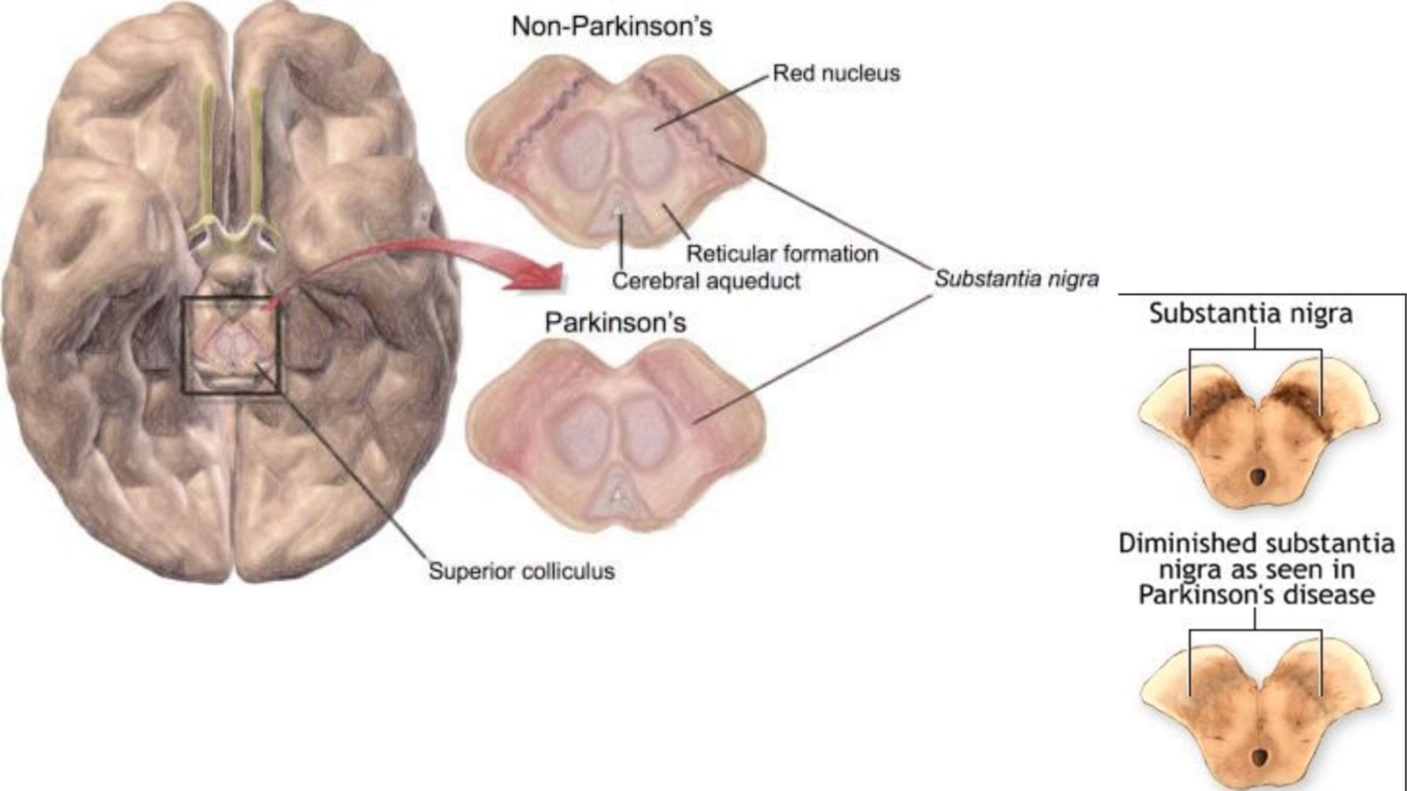 Parkinsons Disease  Medical