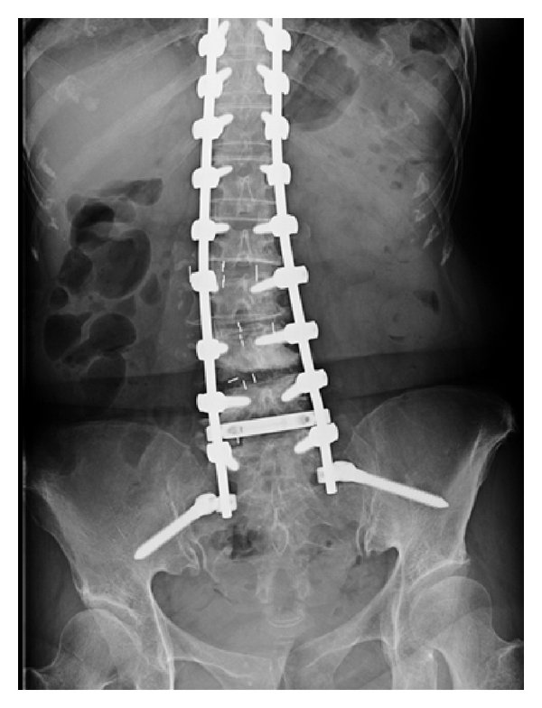 Posterior and Anterior Spinal Fusion for the Management of Deformities ...