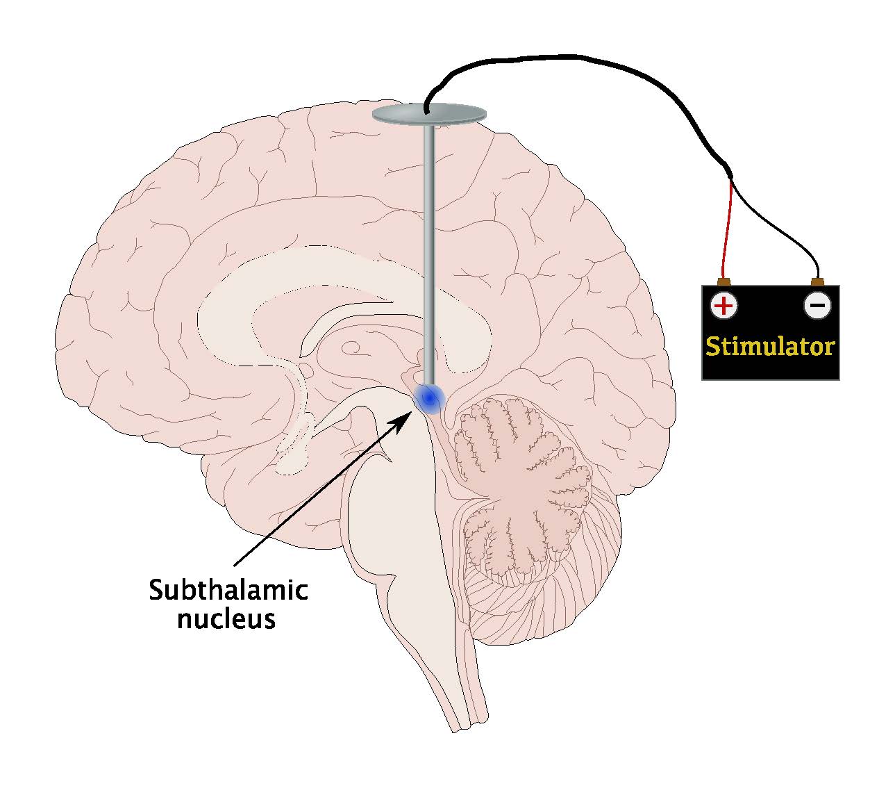 Remote Brain Stimulation: A new treatment for Parkinsons disease ...