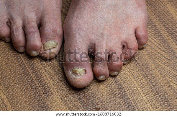 Toes Fungus Parkinsons Disease Stock Photo (Edit Now) 1608716032