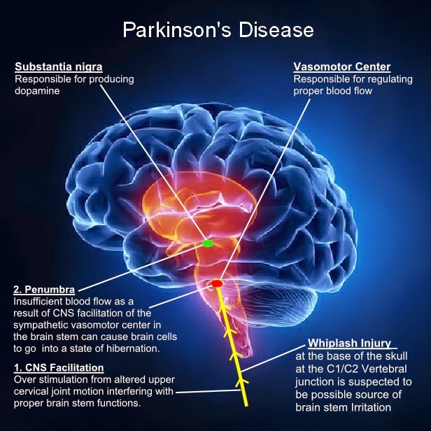 Two studies shows exercise improves symptoms of Parkinsons ...
