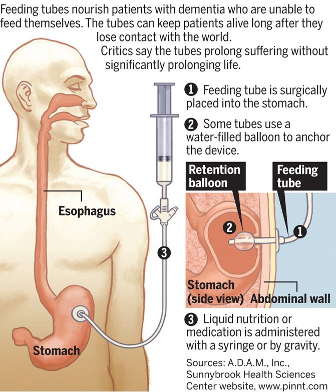 Unfrazzle: End of Life: Is Starvation Better than a Feeding Tube?