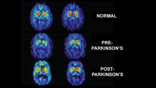 Unlocking Parkinsons Disease