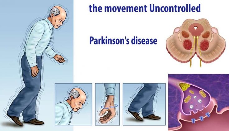 What Are The Symptoms of Parkinson