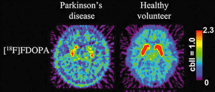 What Can Mimic Parkinson